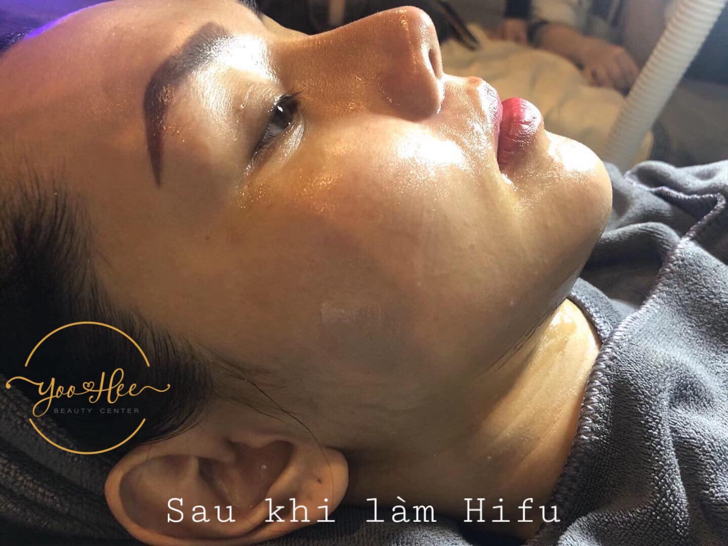 Cấy Mesotox – TẨY SẠCH GỐC NÁM