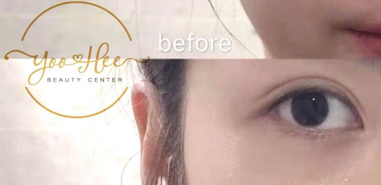 CẤY COLLAGEN TRẺ HOÁ